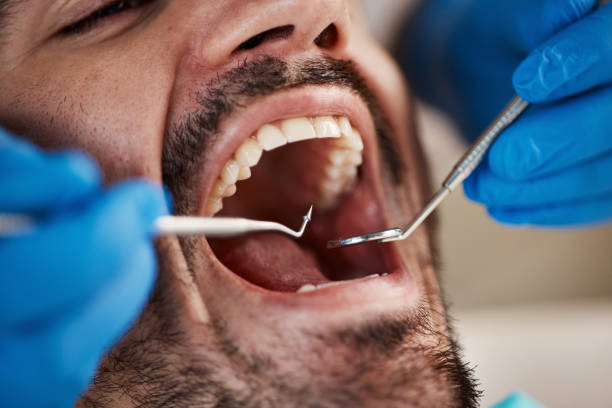 Best Emergency Dentist for Knocked-Out Tooth in Pine Mountain Clu, CA
